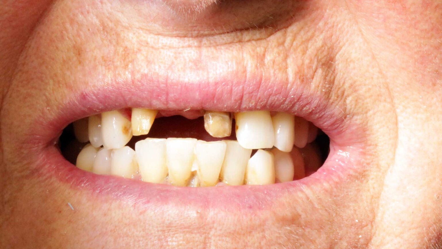 Before And After Dental Cases Denwest Dental Clinic